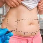 Процедура абдомінопластика