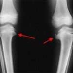 Хвороба Блаунта у дітей: ознаки і лікування