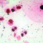 Ознаки і лікування цитомегаловірусу у жінок