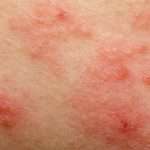 Екзема у дітей на руках