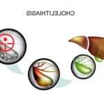 Правила і особливості дієти при холециститі