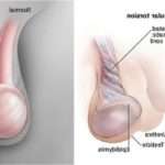 Перекрут яєчка у хлопчиків: причини виникнення, симптоми і методи лікування