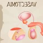 Як проводиться вазектомія