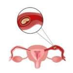 Небезпека позаматкової вагітності і чи можна виявити патологію на ранній стадії