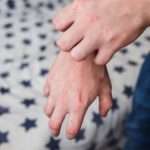 Прищі на ліктях – причини появи та методи лікування