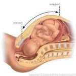 Макросомия плоду: причини виникнення та прогноз