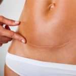 Симптоми і лікування парауретральних кісти у жінок