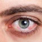 Блефарит у дітей: симптоми і лікування