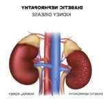 Дисметаболічна нефропатія у дітей