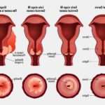 Дискератоз шийки матки – симптоми і лікування