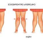 Лікування варусної деформації стоп у дітей