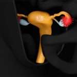 Параметрит – клінічні прояви та підходи до терапії