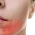 Причини прищів на підборідді в жінок