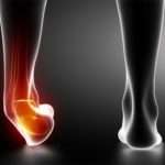 Підвернула ногу: що робити в домашніх умовах, як швидко вилікувати