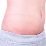 Мастоцитоз у дітей – причини і лікування