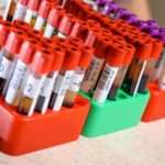 Чому підвищено фібриноген і яка його норма при вагітності