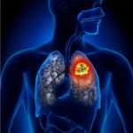 Рак легень у жінок: виявлення та методи лікування