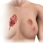 Причини, симптоми і лікування дуктэктазии молочної залози