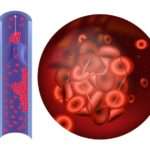 Антифосфоліпідний синдром: опис хвороби, лікування