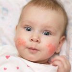 Педіатр пояснила, як відрізнити справжню харчову алергію від удаваної