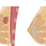 Симптоми і лікування фіброаденоми молочної залози