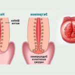 Ектропіон шийки матки: як визначити і вилікувати