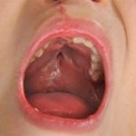 Причини і лікування вовчої пащі у дітей