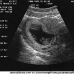 Можлива вагітність після завмерлої вагітності