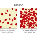 Анемія у дітей: причини, симптоми, лікування