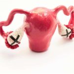 Як визначити і вилікувати дисфункцію яєчників, щоб завагітніти