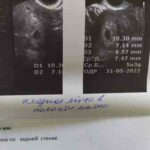 Деформоване пя, гіпертонус по задній стінці