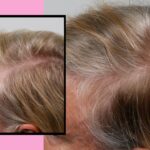 Волшебство Лазерной Ленты: Как Hairmax вернул мне уверенность