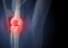 Даремне рентгенівське випромінювання може підштовхнути хворих на артрит до операції