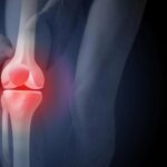 Bezużyteczne promienie rentgenowskie mogą skłonić pacjentów z artretyzmem do operacji