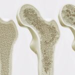 Кости Могут «Тренироваться» Без Движения: Новый Путь к Лечению Остеопороза