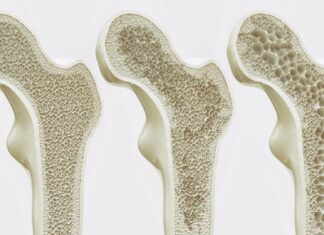Los huesos pueden ‘hacer ejercicio’ sin movimiento: se abre un nuevo camino farmacológico para la osteoporosis