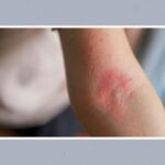 Як це жити з екземою – за словами лікаря-дерматолога