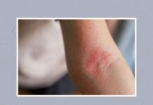 Як це жити з екземою – за словами лікаря-дерматолога