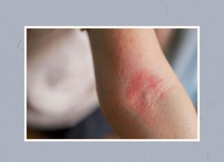 Leben mit Ekzemen: Die Perspektive eines Dermatologen